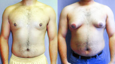 ترهلات الثدي عند الرجال