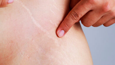 علامات التمدد البيضاء