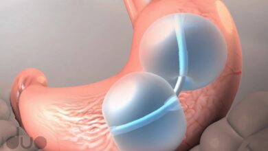 بالون المعدة | تخلص من وزنك بدون عملية جراحية haronefit