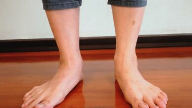 كل ما يجب أن تعرفه عن القدم المسطحة | الأعراض، الأسباب، وهل يمكن علاجها؟ haronefit هارون فيت