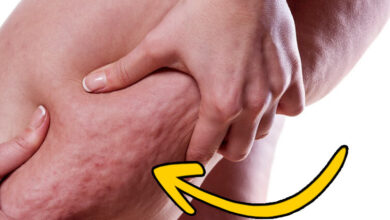 ما هي حقيقة السيلوليت وهل يمكن علاجه نهائيا؟ haronefit